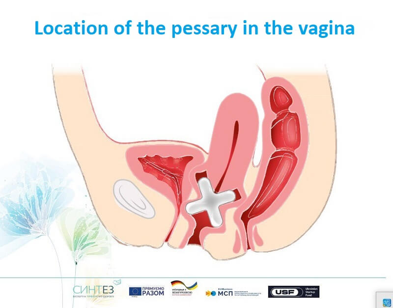 Location of the pessary in the vagina
